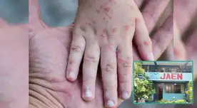 Virus coxsackie en Cajamarca es el nuevo terror de maestros y padres a nivel inicial.