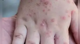 Entre sus principales síntomas está la fiebre y erupciones en la piel.