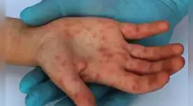 Conoce qué es la viruela del mono y por qué es tan peligrosa.