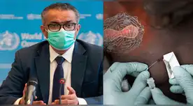 La OMS dio detalles sobre los casos reportados de la viruela del mono.