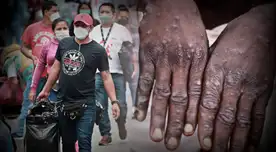 La viruela del mono ya viene afectando a países de Europa y Norteamérica enciendo las alarmas en todo el mundo.