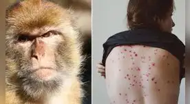 Los niños y adultos mayores podrían ser los más vulnerables frente a la viruela del mono. Los niños y adultos mayores podrían ser los más vulnerables frente a la viruela del mono.