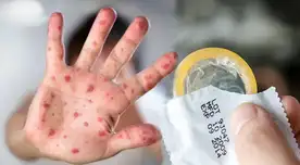 Preservativo protege infecciones como el VHI, pero no la enfermedad de la viruela del mono.