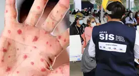 Viruela del mono: SIS asegura que cubrirá de forma gratuita casos de la enfermedad