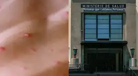 Viruela del mono en Perú: casos aumentan a 183 en el país, confirma el Minsa