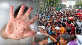 Viruela del Mono se encuentra en etapa comunitaria.