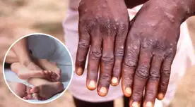 El INS recomendó a la población reducir el número de parejas sexuales, además de evitar el sexo casual, ya que el preservativo no ayuda a evadir el contagio del Monkeypox.