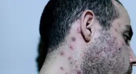 Esta enfermedad sigue propagándose por todo el país.