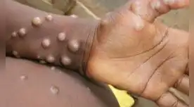 La viruela del mono es una enfermedad que se sigue propagando por el mundo.