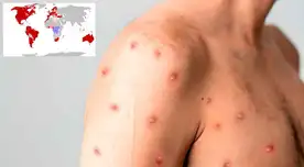Conoce en qué países se han reportado más casos de viruela del mono.