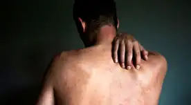 Viruela del mono en Perú: el triste relato de un paciente tras contraer monkeypox: “Son dolores muy fuertes”