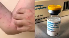 Viruela del mono en Perú: vacunas llegarían al país a inicios de septiembre, indicó la OPS Viruela del mono en Perú: vacunas llegarían al país a inicios de septiembre, indicó la OPS