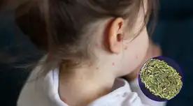 El mayor grupo de riesgo contra la viruela del mono son los niños y mujeres gestantes.