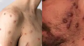 Conoce las diferencias entre la viruela de mono, covid-19 y VIH Conoce las diferencias entre la viruela de mono, covid-19 y VIH