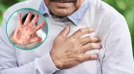 La viruela del mono se transmite por contacto estrecho con lesiones, fluidos corporales o aerosoles. La viruela del mono se transmite por contacto estrecho con lesiones, fluidos corporales o aerosoles.