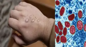 La viruela del mono se sigue propagando por el mundo. La viruela del mono se sigue propagando por el mundo.