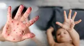 Conoce cuáles son las recomendaciones para cuidar a tus hijos de la viruela de mono Conoce cuáles son las recomendaciones para cuidar a tus hijos de la viruela de mono