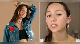 Alexia Barnechea muestra su acné. Alexia Barnechea muestra su acné.