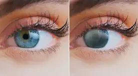 Catarata se mantiene como mayor causa de ceguera en el país, pese a que es reversible.