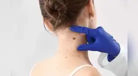 Si tienes un lunar que cambia de color, tamaño o forma, acude a un médico.