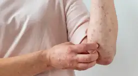 Especialista que habla de preocupante enfermedad.