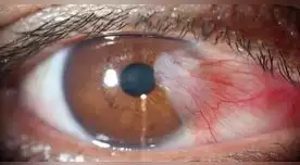 Cuidado con las cataratas en los ojos.