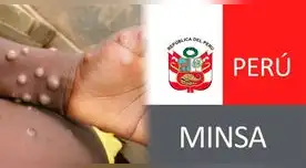 Minsa declaró alerta epidemiológica a largo del país por viruela del mono.