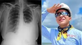 ‘Ingeniero bailarín’ tuvo derrame pleural.