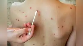 Hay que estar atentos a síntomas como fiebre, erupciones cutáneas, dolor muscular o fatiga.