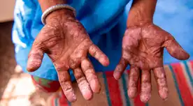 Digesa Piura confirma el primer caso de lepra en este 2025.