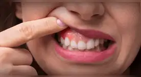 Periodontitis: la enfermedad dental que podría aumentar el riesgo de cáncer de colon.