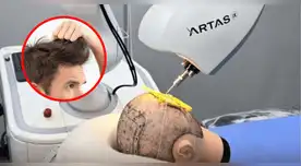 ARTAS iX, el robot que pondrá fin a la calvicie.