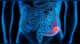 Cuidado con el cáncer de colon.