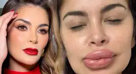 Laura Spoya sufre reacción alérgica tras retoque estético y queda IRRECONOCIBLE: “Se estaba hinchando”