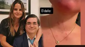 Silvia Núñez del Arco compartió que le rasguñaron el cuello.