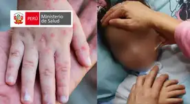 Virus Coxsackie o enfermedad de manos, pies y boca: qué es, cómo se contagia y a quién ataca.