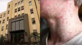 URGENTE | Minsa reporta más de 153 casos de sarampión en Perú: virus amenaza con expandirse.