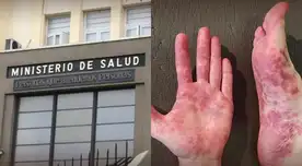 No solo afecta a niños | Minsa revela SÍNTOMA CLAVE del virus Coxsackie que los adultos no deben ignorar.