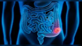 Cáncer de colon