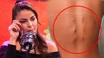 Laura Spoya DEJA EN SHOCK al reaparecer y mostrar cómo quedó su espalda tras su operación