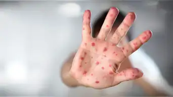 Casos de sarampión se CUADRUPLICAN en solo 72 horas pese alerta sanitaria en esta región