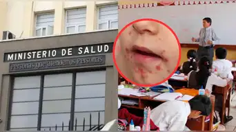 Alerta por Virus Coxsackie: epidemiólogo del Minsa advierte hasta cuándo aumentarían los casos en colegios