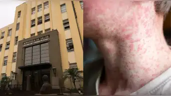 URGENTE | Minsa reporta 153 casos de sarampión en Perú: revisa las regiones donde el virus se expande