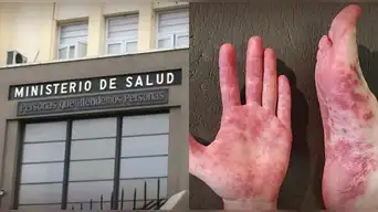 No solo afecta a niños | Minsa revela SÍNTOMA CLAVE del virus Coxsackie que los adultos no deben ignorar