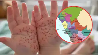 ALERTA por VIRUS COXSACKIE en PERÚ: región supera los 500 casos y evalúan suspensión de clases