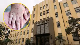 URGENTE | Gobierno declara EMERGENCIA SANITARIA por brote de SARAMPIÓN en Lima y 12 regiones: esto se sabe
