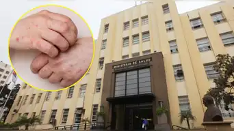 Alerta sanitaria por Sarampión: puntos de vacunación, cuántas dosis se necesitan y cómo saber si estás inmunizado