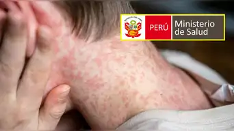 URGENTE | MINSA confirma más de 300 casos de SARAMPIÓN en esta región y anuncia medidas sanitarias extremas