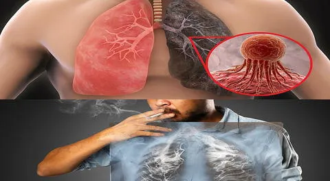 Deje el cigarro, este es un aliado del cáncer de pulmón.