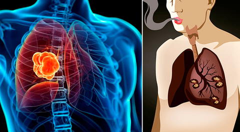 Síntomas iniciales y qué tratamiento se utiliza para el cáncer de pulmón.